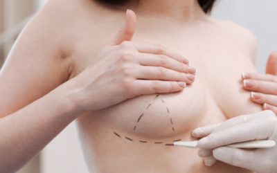Breast Augmentation Scars: All You Need To Know