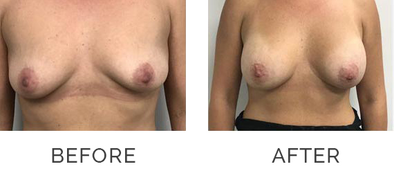 Breast-Implants