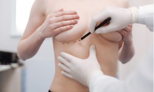 breast reconstruction consultation
